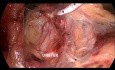 Laparoskopische totale Proktokolektomie mit endständiger Ileostomie