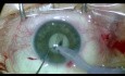 Cataracta hypermatura + 3,5mm Pupille + PEX