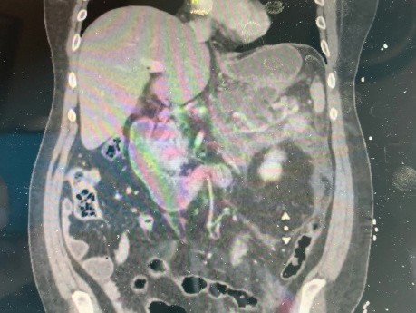 Zystgastrostomie mit Stent