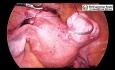 Entfernung des Myoms im Ligamentum latum uteri