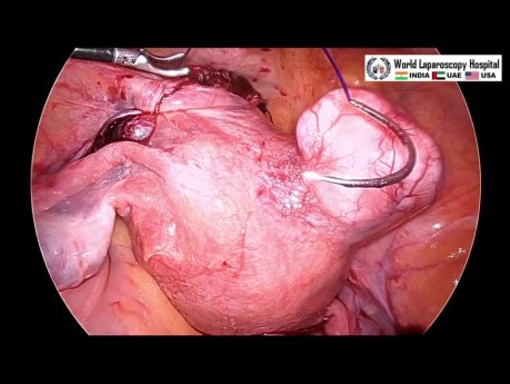 Entfernung des Myoms im Ligamentum latum uteri