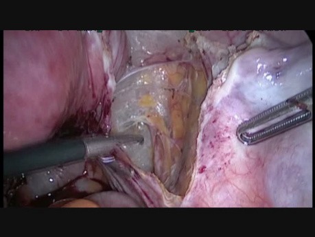 Ureterolyse (der rechte Harnleiter)
