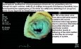 Funktionelle Mitralinsuffizienz: 2D- und 3D-Transösophageale Echokardiographie (2D- und 3D-TEE)