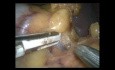 Laparoskopische Splenektomie bei multiplen Aneurysmen der Arteria splenica