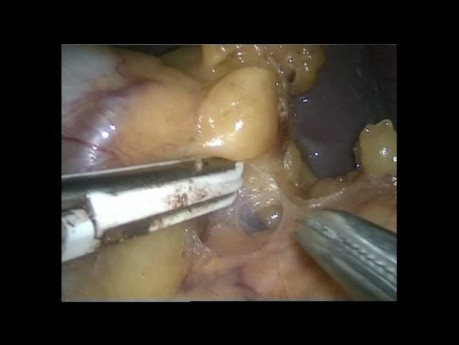 Laparoskopische Splenektomie bei multiplen Aneurysmen der Arteria splenica