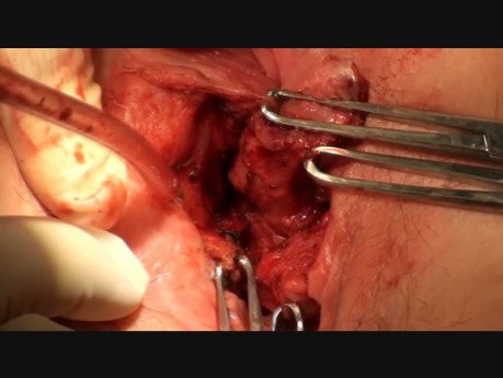 Operative Therapie einer traumatischen rektovaginalen Fistel