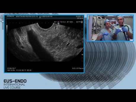  Endosonographisch gesteuerte Feinnadel-Aspiration (EUS- FNA)