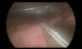 Dünndarmperforation bei Bauchtrauma – Laparoskopischer Ansatz