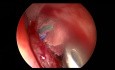Vollständige endoskopische Nasennebenhöhlenoperation bei chronischer Rhinosinusitis des Keilbeines