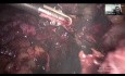 Totale laparoskopische Hysterektomie bei Endometriose (Stadium 3 und Stadium 4)- WEBINAR