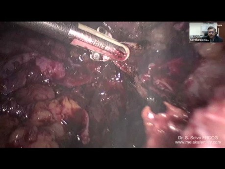 Totale laparoskopische Hysterektomie bei Endometriose (Stadium 3 und Stadium 4)- WEBINAR