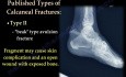 Fersenknochenverletzung und Fersenbeinabrissfrakturen – Videovortrag