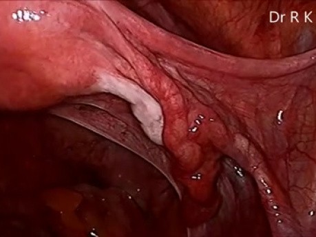 Totale laparoskopische Hysterektomie (Mishra's Knot) 