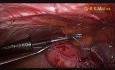 Totale laparoskopische Hysterektomie und bilaterale Salpingo-Oophorektomie 