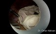 Laparoskopische Salpingektomie bei Extrauteringravidität