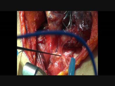 Intraoperatives Monitoring des N. recurrens während der Thyreoidektomie mit NIM-Response 3.0