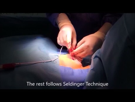 Vena subclavia - Port-A-Cath implantacjon