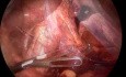 Laparoskopische Reparatur von Hiatushernien