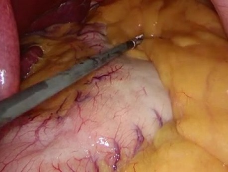 Laparoskopische Sleeve Gastrektomie