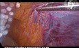 Lipome des Samenstrangs