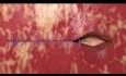 Verschluss der Vaginalmanschette mit unidirektionalem Quill®-Nahtmaterial mit Widerhaken