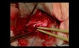 Hämangioblastom der Halswirbelsäule C2