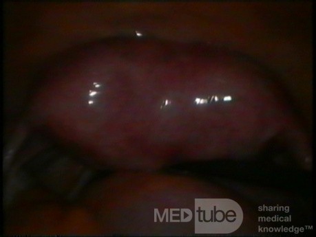 Uterus septus