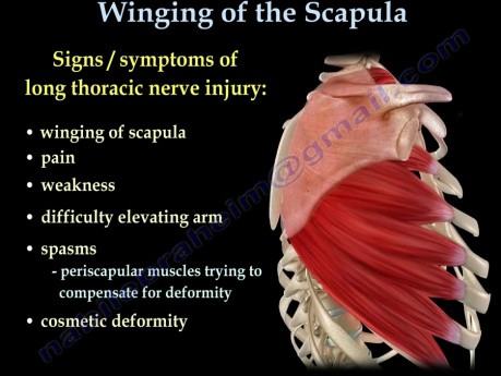 Scapula alata - das flügelartige Abstehen des Schulterblatts, Behandlunngsmethoden