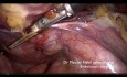 Tipps und Tricks. Subtotale Hysterektomie für 1340 Gramm Uterus.