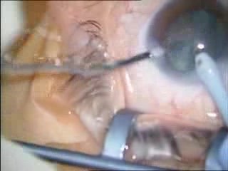 Kataraktchirurgie – Phakoemulsifikation
