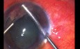 Intraokularer Fremdkörper im Vorderabschnitt des Auges