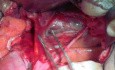 Beckenanatomie - 3 hintere avaskuläre Räume und ihre Bedeutung bei der radikalen Hysterektomie