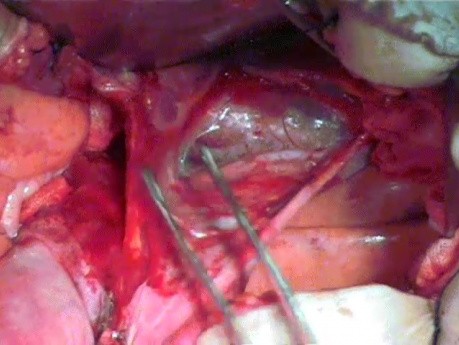 Beckenanatomie - 3 hintere avaskuläre Räume und ihre Bedeutung bei der radikalen Hysterektomie
