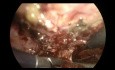 Prostatosymphysäre Fistel. Extraperitoneale laparoskopische Korrektur.