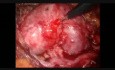 Laparoskopische Pyelolithotomie bei der Hufeisenniere