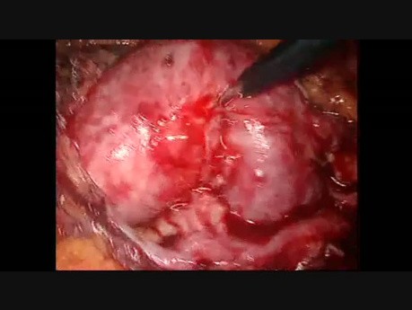 Laparoskopische Pyelolithotomie bei der Hufeisenniere