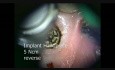 Entfernung eines gebrochenen Implantat-Abutments