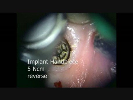Entfernung eines gebrochenen Implantat-Abutments