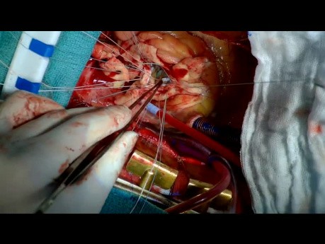 Operation des aufsteigenden Aortenaneurysmas mit Aorteninsuffizienz unter Verwendung einer Gefäßprothese
