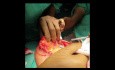 Brusterhaltende Operation (Rundblock/Donut-Mastopexie) bei Brustkrebs