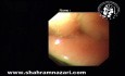 Endoskopie bei großer Hiatushernie mit intrathorakalem Magen