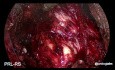 Laparoskopische radikale Prostatektomie mit der Retzius-Sparing-Technik
