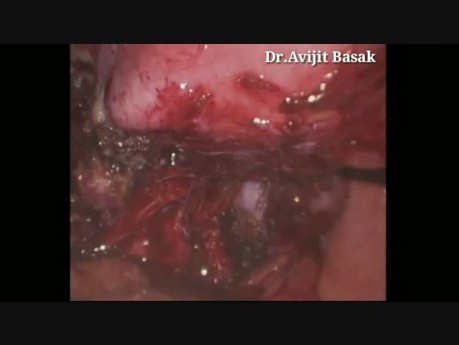 Totale laparoskopische Hysterektomie und bilaterale Salpingo-Oophorektomie bei Endometriose