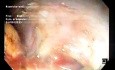 ESD eines riesigen 11 x 5 cm großen LST-G-Mischtyps bei einem Patienten mit Gebrechlichkeitssyndrom