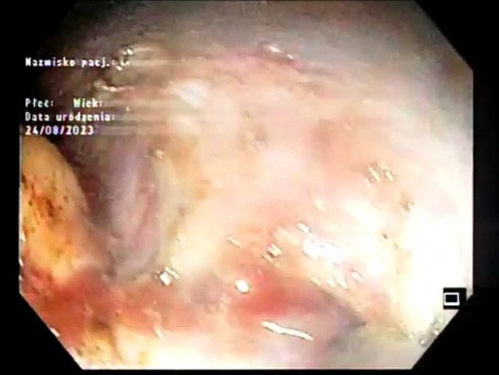 ESD eines riesigen 11 x 5 cm großen LST-G-Mischtyps bei einem Patienten mit Gebrechlichkeitssyndrom