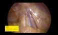 Beispiele der Leistenanatomie bei verschiedenen Patienten und Hernientypen