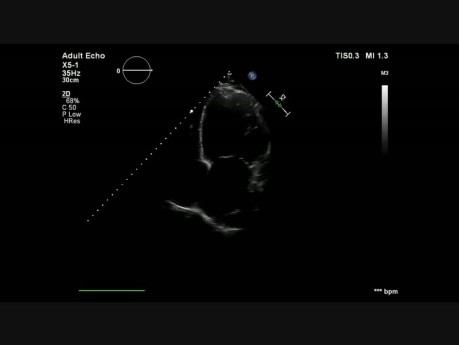 Dilatative Kardiomyopathie mit einem apikalen Thrombus