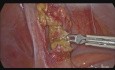 Laparoskopische Appendektomie bei akuter Blinddarmentzündung infolge eines Wurmbefalls
