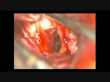 Hirnaneurysma (Aneurysma der vorderen kommunizierenden Arterie) – Ausschnitt