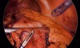 Laparoskopische subtotale Gastrektomie zur Behandlung blutender Polypen